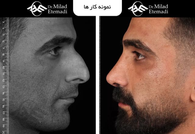 نمونهکار جراحی زیبایی بینی از دکتر میلاد اعتمادی