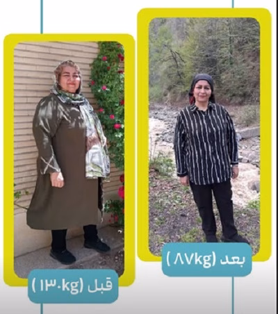 نمونهکار اسلیو معده از دکتر محسن محمودیه