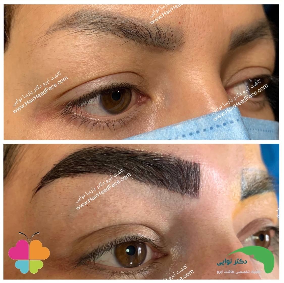 نمونهکار کاشت ابرو از کلینیک کاشت مو و ابرو دکتر نوایی