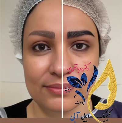 نمونهکار کاشت ابرو از کلینیک زیبایی رویایی آبی