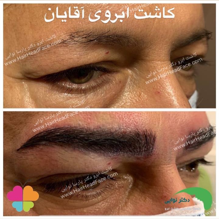 نمونهکار کاشت ابرو از کلینیک کاشت مو و ابرو دکتر نوایی