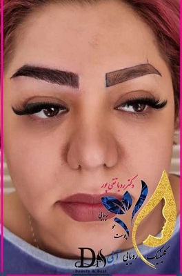 نمونهکار کاشت ابرو از کلینیک زیبایی رویایی آبی