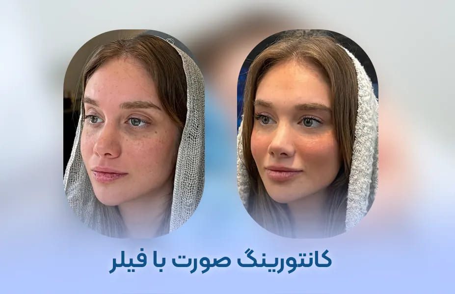 زاویه فک شیراز